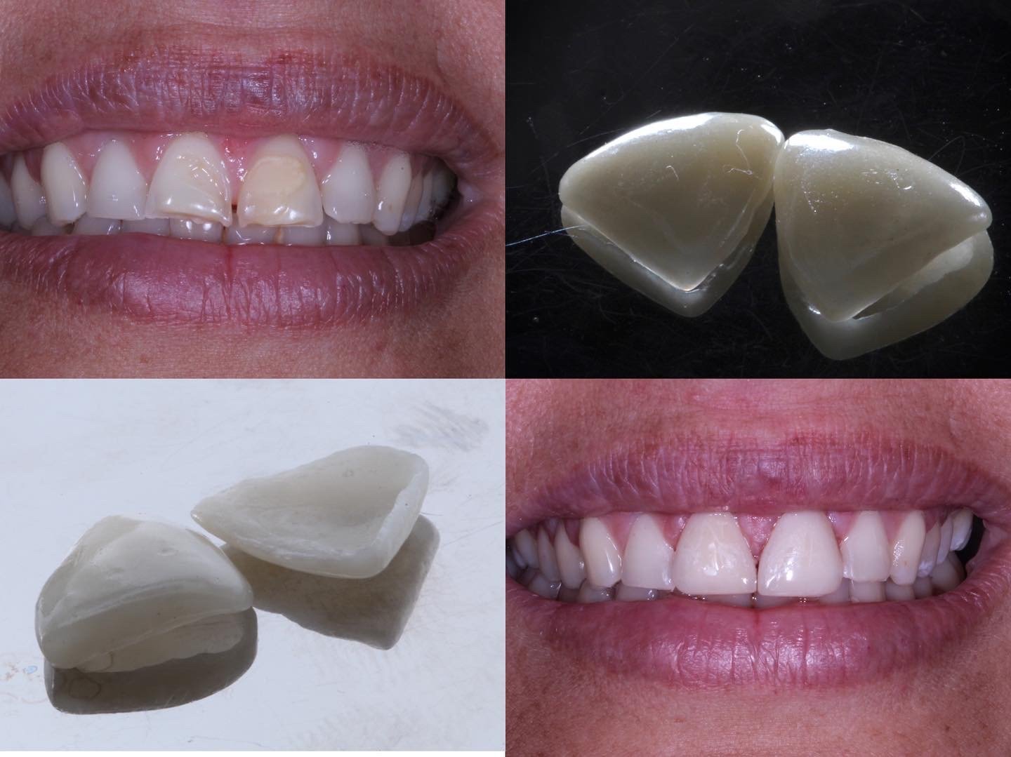 Estética Dental & Carillas